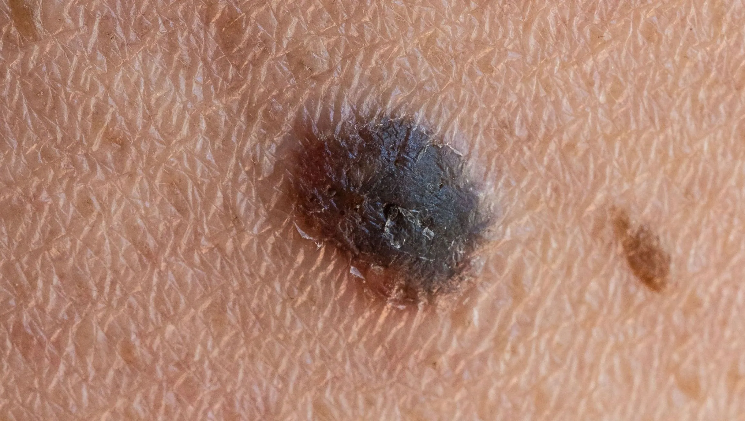 Personalized mRNA Therapy Marks a Turning Point in the Fight Against Skin Cancer
